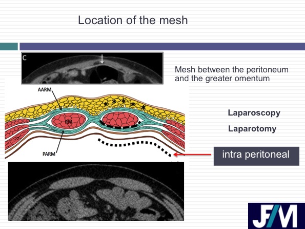 CT findings after abdominal wall repair surgery