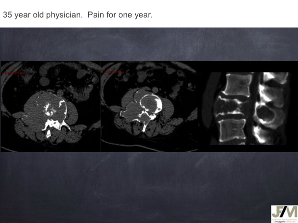 Mistakes in diagnosing of a Bone Tumor