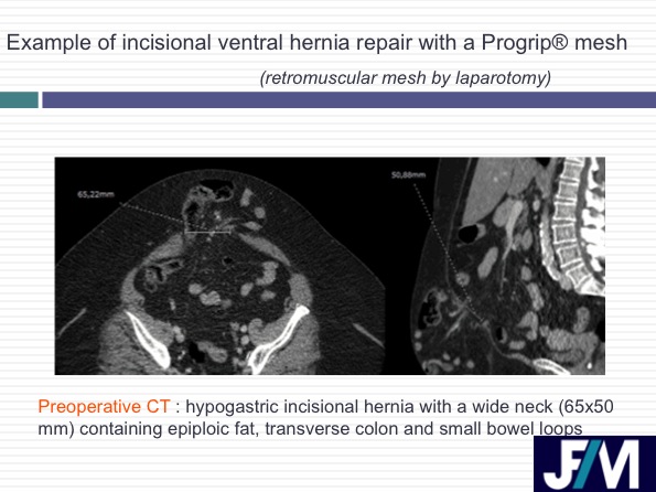 CT findings after abdominal wall repair surgery