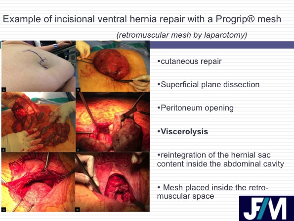CT findings after abdominal wall repair surgery