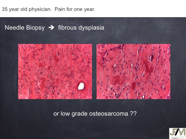 Mistakes in diagnosing of a Bone Tumor