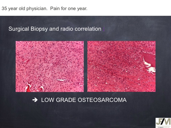 Mistakes in diagnosing of a Bone Tumor