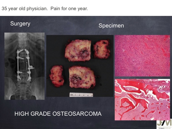 Mistakes in diagnosing of a Bone Tumor