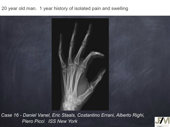 Mistakes in diagnosing of a Bone Tumor