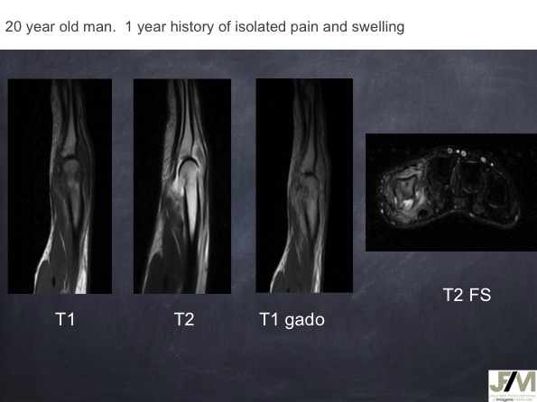 Mistakes in diagnosing of a Bone Tumor