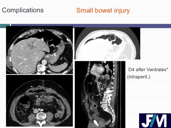 CT findings after abdominal wall repair surgery
