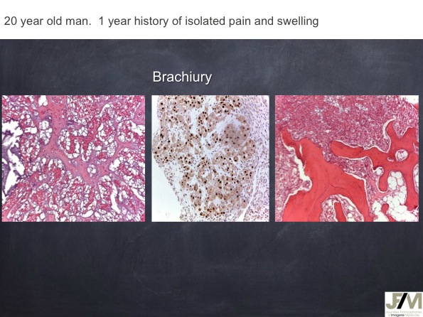 Mistakes in diagnosing of a Bone Tumor