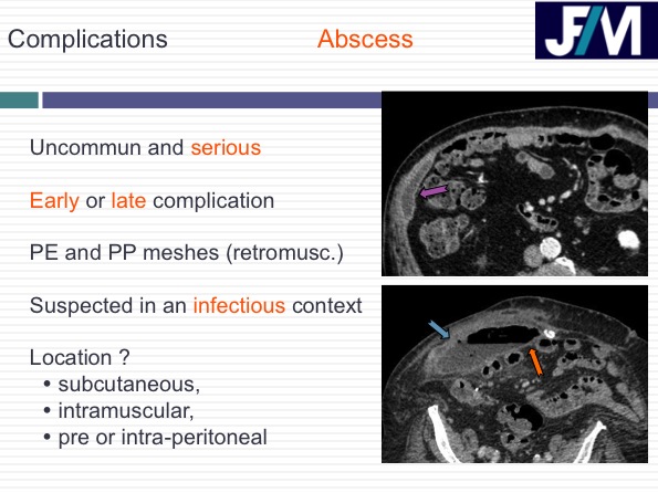CT findings after abdominal wall repair surgery