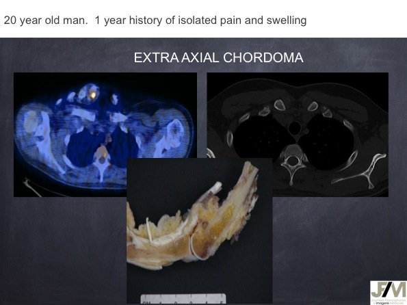 Mistakes in diagnosing of a Bone Tumor