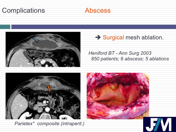 CT findings after abdominal wall repair surgery
