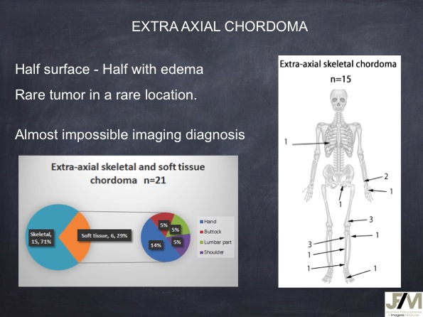 Mistakes in diagnosing of a Bone Tumor