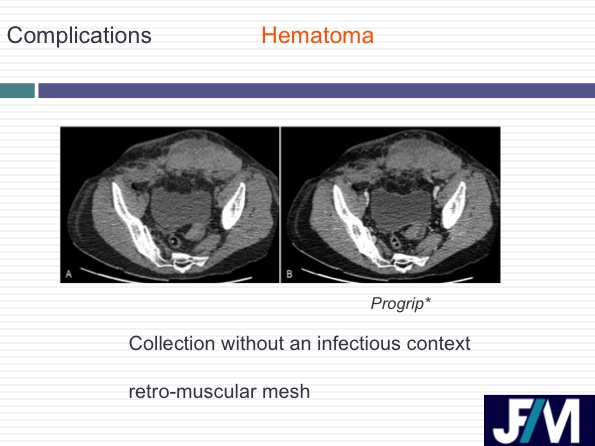 CT findings after abdominal wall repair surgery