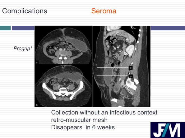 CT findings after abdominal wall repair surgery