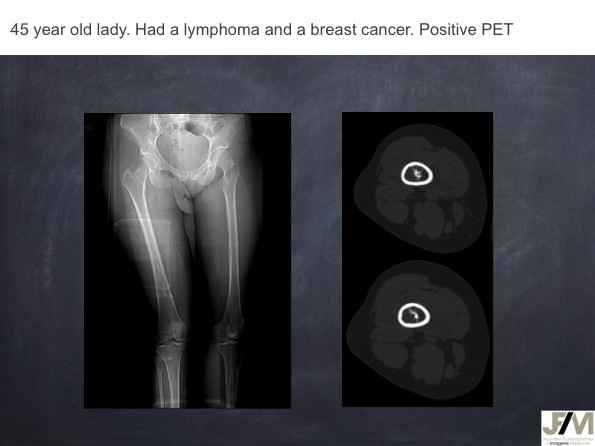 Mistakes in diagnosing of a Bone Tumor