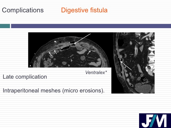 CT findings after abdominal wall repair surgery