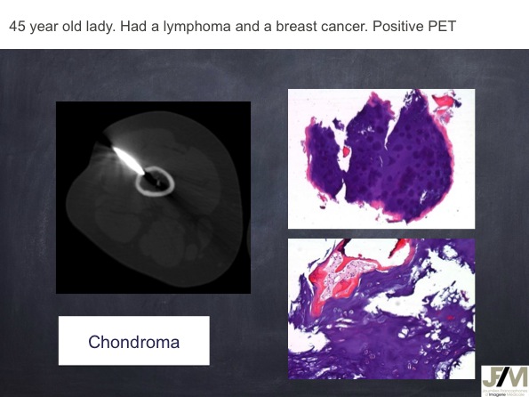 Mistakes in diagnosing of a Bone Tumor