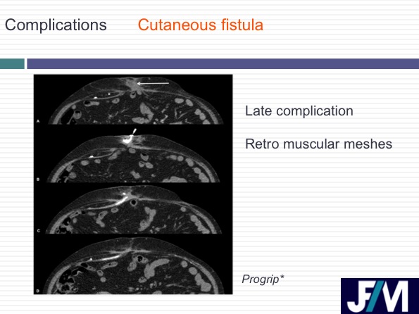 CT findings after abdominal wall repair surgery