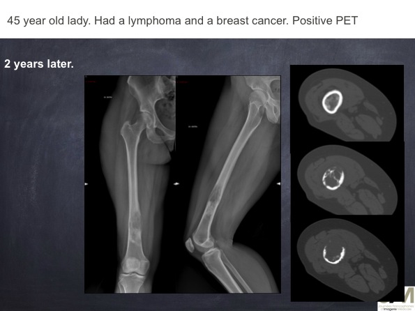 Mistakes in diagnosing of a Bone Tumor