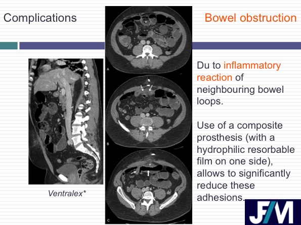 CT findings after abdominal wall repair surgery