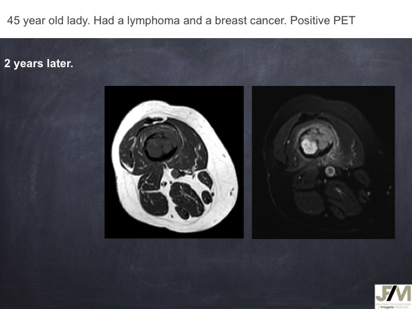 Mistakes in diagnosing of a Bone Tumor