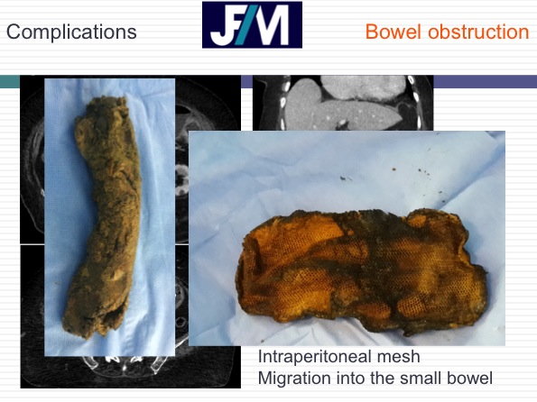 CT findings after abdominal wall repair surgery