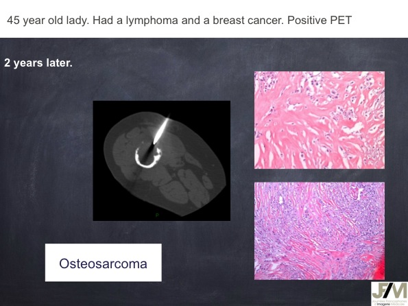 Mistakes in diagnosing of a Bone Tumor