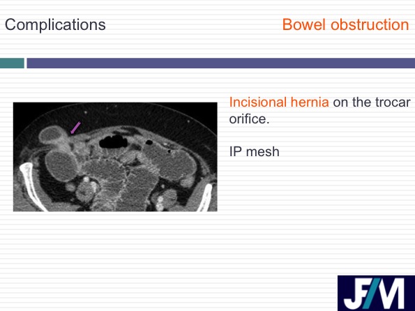 CT findings after abdominal wall repair surgery