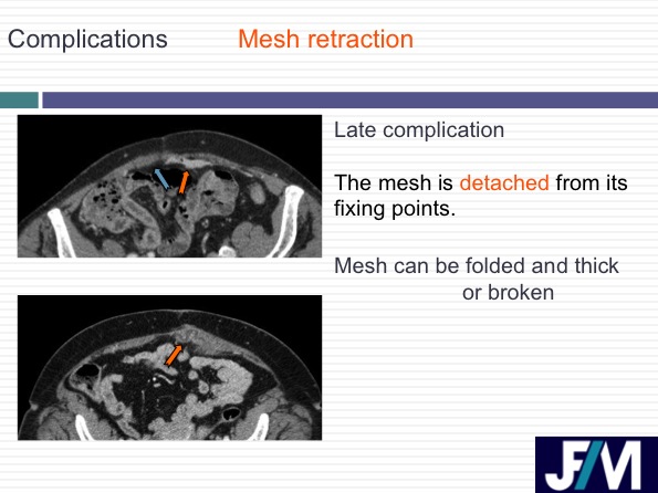 CT findings after abdominal wall repair surgery
