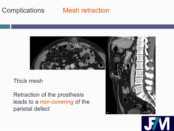 CT findings after abdominal wall repair surgery