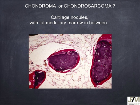 Mistakes in diagnosing of a Bone Tumor