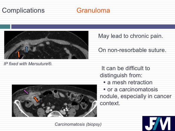 CT findings after abdominal wall repair surgery