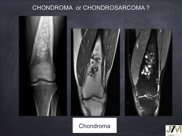 Mistakes in diagnosing of a Bone Tumor