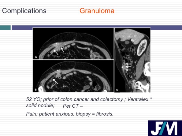 CT findings after abdominal wall repair surgery