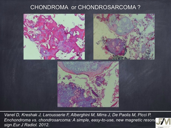 Mistakes in diagnosing of a Bone Tumor