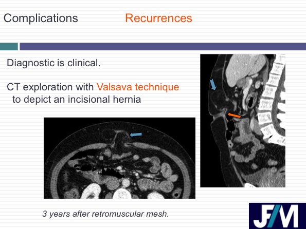 CT findings after abdominal wall repair surgery