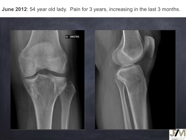 Mistakes in diagnosing of a Bone Tumor