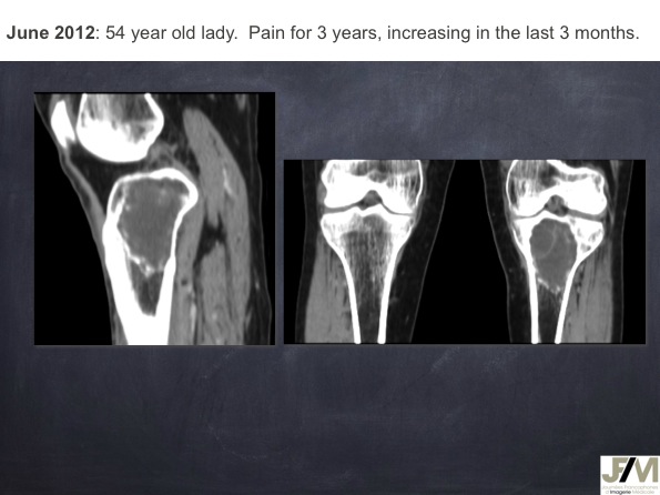 Mistakes in diagnosing of a Bone Tumor