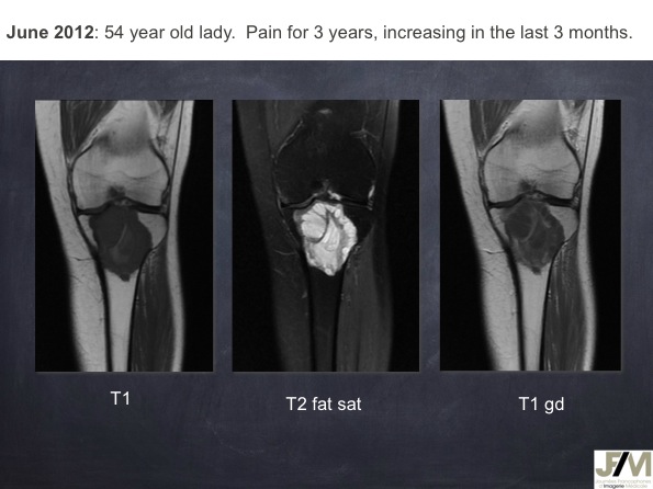 Mistakes in diagnosing of a Bone Tumor