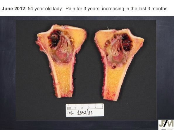 Mistakes in diagnosing of a Bone Tumor