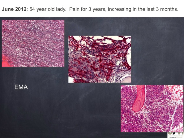 Mistakes in diagnosing of a Bone Tumor