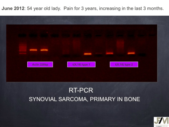 Mistakes in diagnosing of a Bone Tumor
