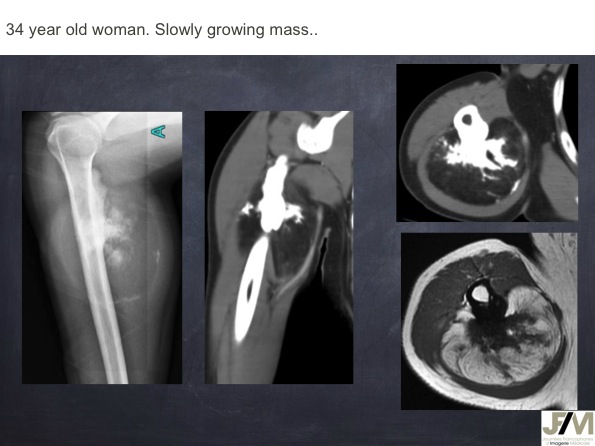 Mistakes in diagnosing of a Bone Tumor
