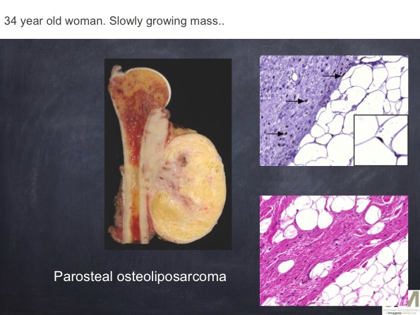 Mistakes in diagnosing of a Bone Tumor