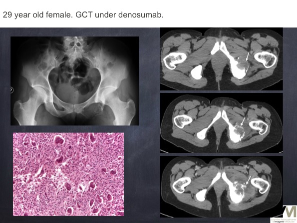 Mistakes in diagnosing of a Bone Tumor