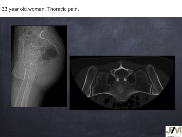 Mistakes in diagnosing of a Bone Tumor