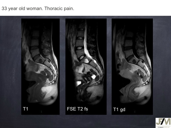 Mistakes in diagnosing of a Bone Tumor
