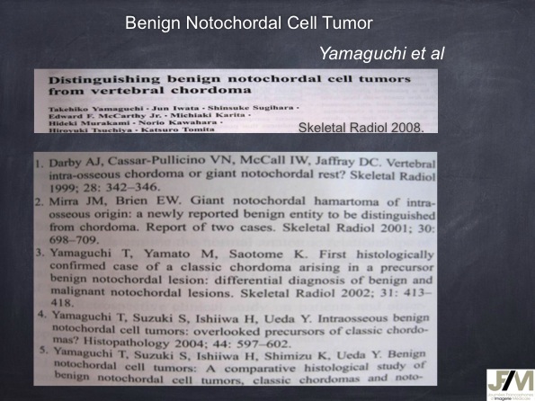 Mistakes in diagnosing of a Bone Tumor