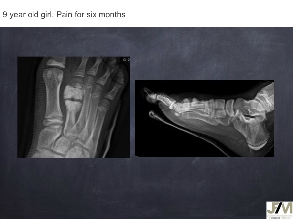 Mistakes in diagnosing of a Bone Tumor