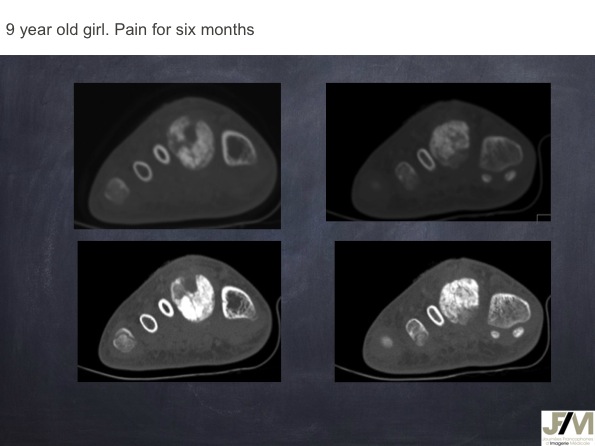 Mistakes in diagnosing of a Bone Tumor