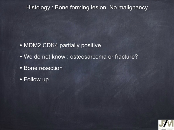 Mistakes in diagnosing of a Bone Tumor